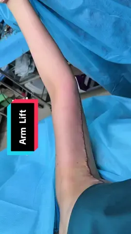 Part 39|  Arm Tightening Surgery – Day 4 Reveal for International Clients 💖 #armlift #arm #slimarms #beforeafter #fyp 