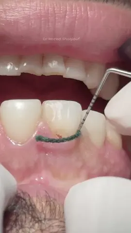 Composite veneer for anterior teeth after removal of old restoration #dentist #LIVEIncentiveProgram #LIVEwithlowfollowers #PaidPartnership 