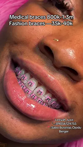 Smile on a budget 💕😍#fashionbracesinojodu #fashionbracesinlagos #fashionbraces #fashion #fyppppppppppppppppppppppp 