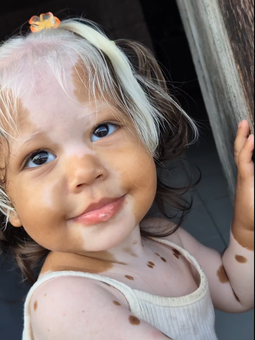 🤍 . . . . #beautiful #babylove #babygir💗💗💗💖💖💖❣️ #piebaldism #foruyou 