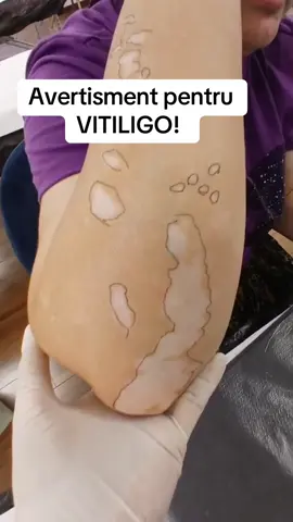 Ce este Skin Story?  Unica metodă de camuflare VITILIGO -corecta ,și eficientă !  Da,spun asta pentru ca sunt singura din România cu cei mai mulți clienți ,și expertiza !  Centrele unde se pot face procedurile sunt în Constanta și București (26-27 septembrie )  #vitiligopoatesadispara #vitiligosetrateaza #faravitiligo #SkinStory 