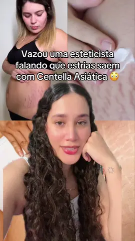 Depois que eu aprendi a tratar estrias com Centella asiática, sou outra mulher 💕