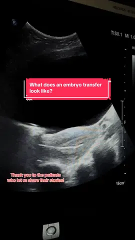 It’s my favorite day for my patients who have worked so hard to get here!  #stickbabystick #ivf #fet #getpregnant #fyp 