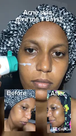 @PURITO SEOUL #Purito #PanthenolCream #AcneTreatment #RealPostAcneCream #RealPostAcneCreamChallenge