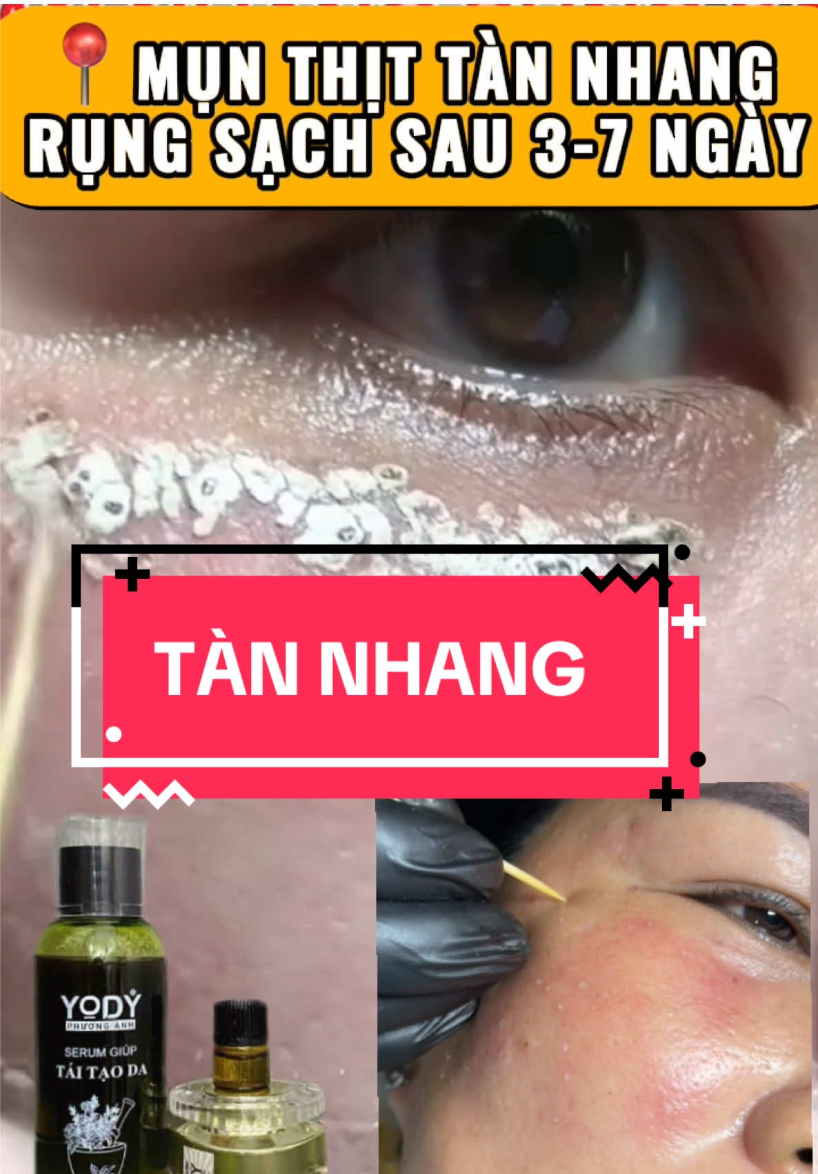 🌳TÀN NHANG DỄ LẮM CÁC CHỊ - CHẤM 3-7 ngày rụng sạch chân #tàn_nhang #peelda #hảo_chăm_da #trendingreels #làmđẹp 