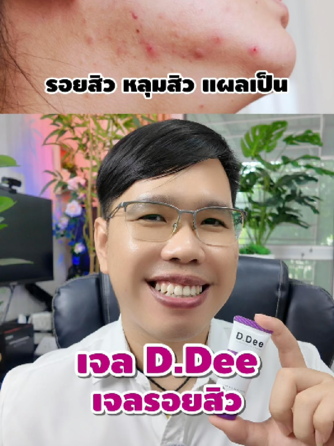 ไม่อยากเป็นรอยสิวถาวรหยุดฟังเลย #ddee #เจลรอยสิว #รอยสิว #รอยดำ #แผลเป็น