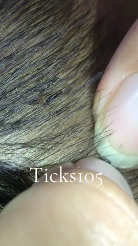 remove to stop itching#😭😭😭 #😱😱😱omg #liceremoval #🥶🥶🥶 #😍😍😍 