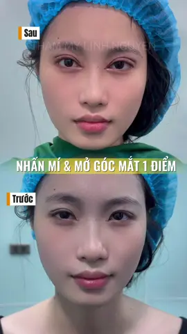 Combo hoàn hảo cho các bạn mắt nhỏ muốn thay đổi hoàn toàn phom mắt😉 #thammylinhnguyen #nhanmi #canchinhkhuonmat #mogocmat1diem #mogocmat 