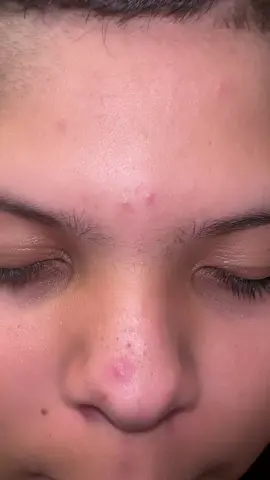 Acné #acne #neutrogena #acnetreatment #acneskincare #granos 
