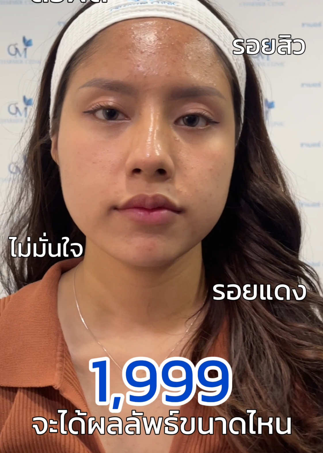 สิวหาย รอยจาง หน้าใสขึ้น ผลลัพธ์เกินคุ้ม✨ #charmerclinic #หน้าใสไร้สิว #รีวิวบิวตี้ในtiktok #skinbooster #glassskin 