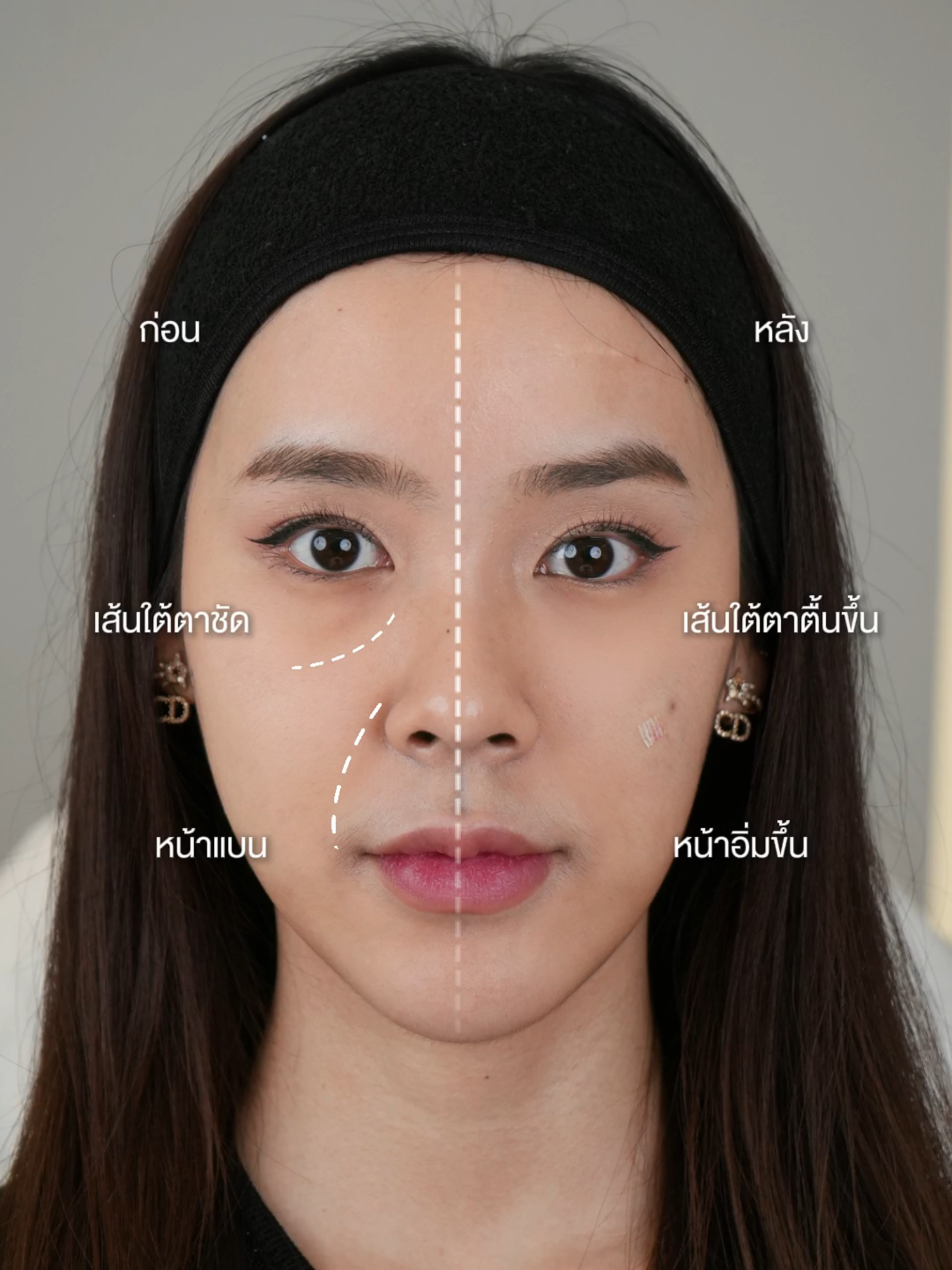 ไขมันหาย หน้าดูไม่มีมิติ แถมเห็นเส้นใต้ตา โปรแกรมฟิลเลอร์ช่วยได้‼️👍 #patamaclinic #ปัทมาคลินิก #fyp #filler #ใต้ตาดํา