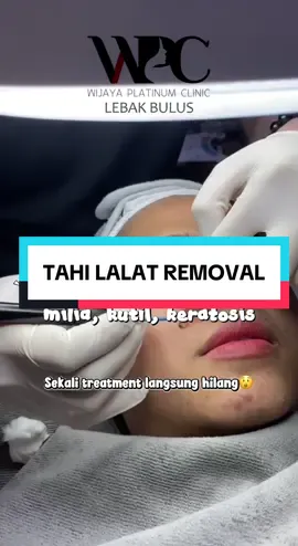 Cauter treatment🥰 #wpclebakbulus #wijayaplatinumclinic #tahilalat #cauter #fyp 