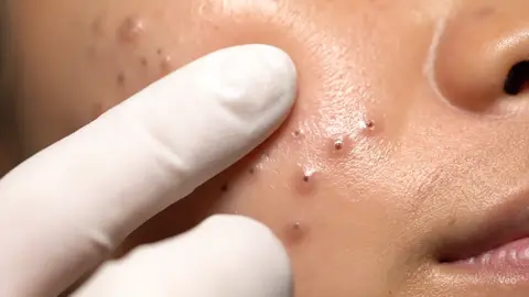 #blackhead #กดสิว #ถอนขน #acnetreatment #acneskincare 