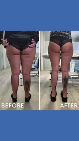 Se desideri migliorare un aspetto del tuo corpo, potrebbe esserci un rimedio... Immagina un percorso personalizzato che, a seguito di una valutazione medica, prevede procedure medicali non invasive, senza tempi di recupero e senza bisturi. Si tratta del Metodo Forma Sana, che ha già accompagnato tantissimi italiani verso un benessere su misura. Scopri di più 👇 📞 02 2111 7015 📧 info@centromedicoformasana.it 🌐 www.centromedicoformasana.it @centromedicoformasana #centromedicoformasana #medico #medicoestetico #centromedico #salute #salutebenessere #milano #centromedicomilano #medicinaestetica #doc #centromedicobrughiero #consulenzamedica #guardiamedicaprivata Centro Medico Forma Sana di Forma Sana Srl | P. IVA 11896620967 | Informazione sanitaria ai sensi delle leggi 248/2006 e 145/2018 | Direttore Sanitario - Dott.ssa Alessandra Patti, Medico Chirurgo (OMCeOMB 5101)