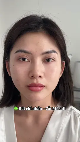 Rút chỉ nhấn - Cắt Mí Full 