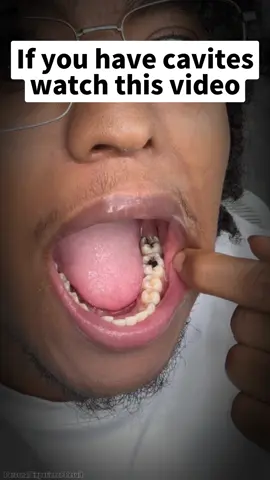 If you have cavites watch this video#teeth #brush #fnny #animation #explor #😂😂😂 #fypシ #🦷 #caries #outdoorfun #ceelike #toothpaste #hydroxyapatite #whiteningteeth #teethcleaning #dealsforyoudays