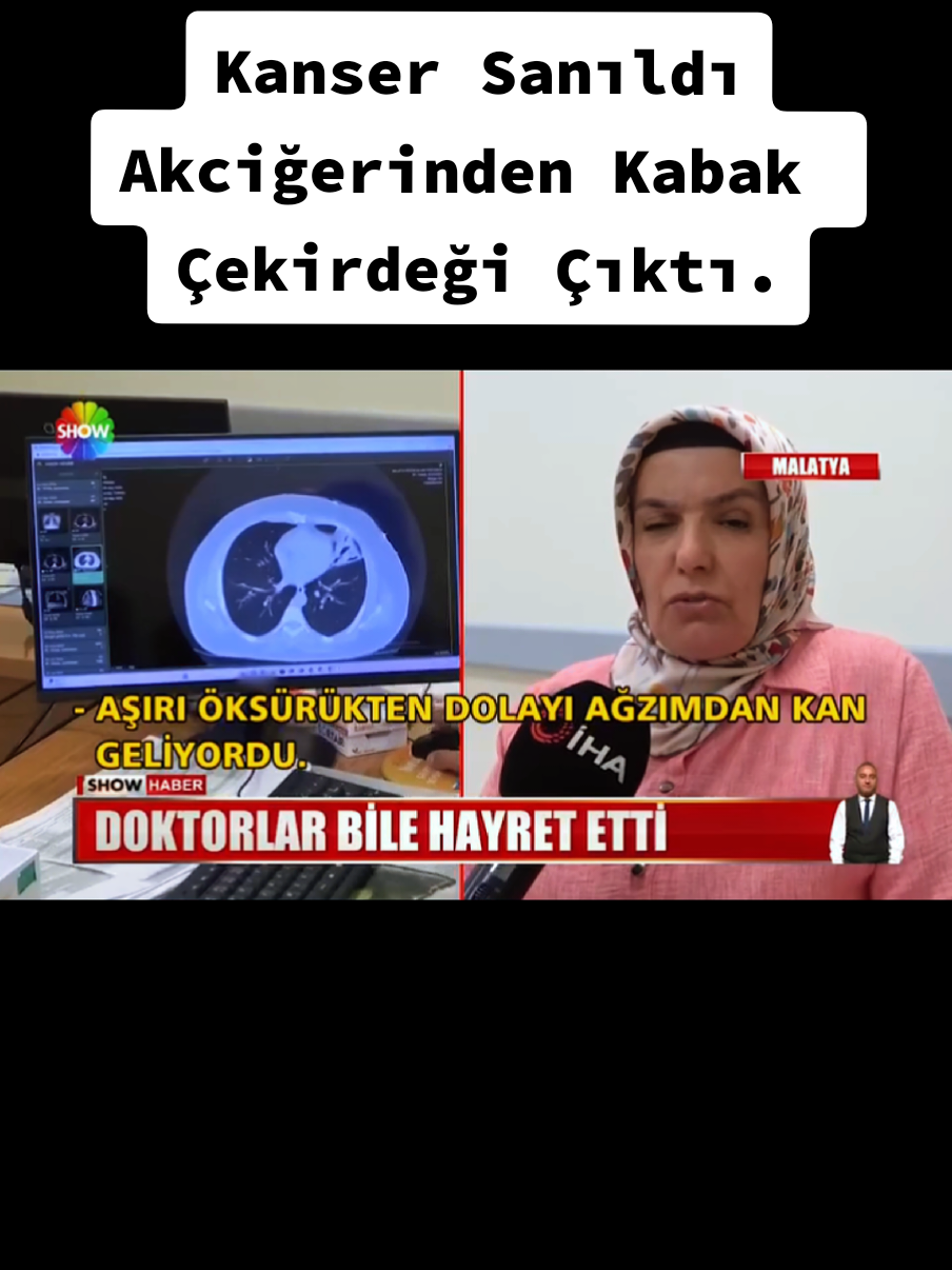 Kanser Sanıldı Akciğerinden Kabak Çekirdeği Çıktı. #malatya #haber #kanser #kadın #kahramanmaraş 