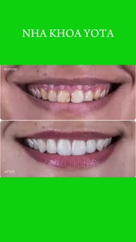 Làm răng sứ cho răng sâu kẽ #nhakhoayota #niềngrăng #răngsứ #nhổrăngkhôn #răngtrẻem                 