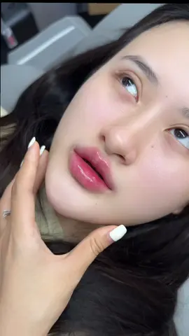 Cộng 1 form môi tự nhiên cho các chị tham khảo, tiêm xong đi chơi luôn k ai nhận ra là vừa tiêm🥰🥰#tiemmoidep #moibaby #fillerbotox #tiemmoifiller #moitay 