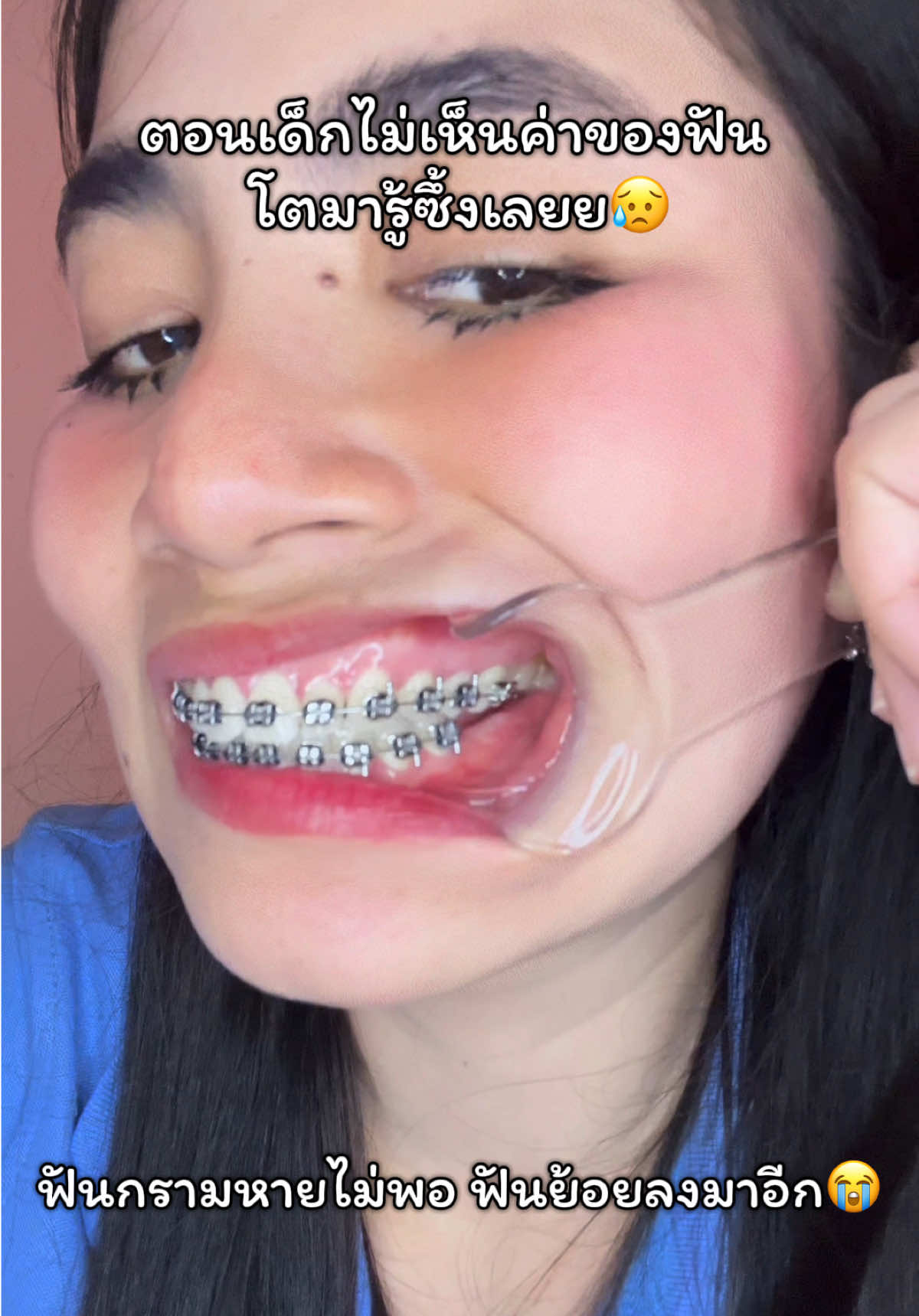 การมีฟันครบถือว่าโชคดีที่สุดแล้ว🦷 #ฟันกรามหาย #ฟันกราม #ถอนฟัน #ฟันผุ #จัดฟันเปลี่ยนชีวิต 