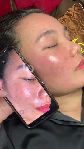 Cập nhật da nám  #lấynhanmunbangtay#chamsocdamun#chamsocdaseo#chamsocdanam#tanbinh    