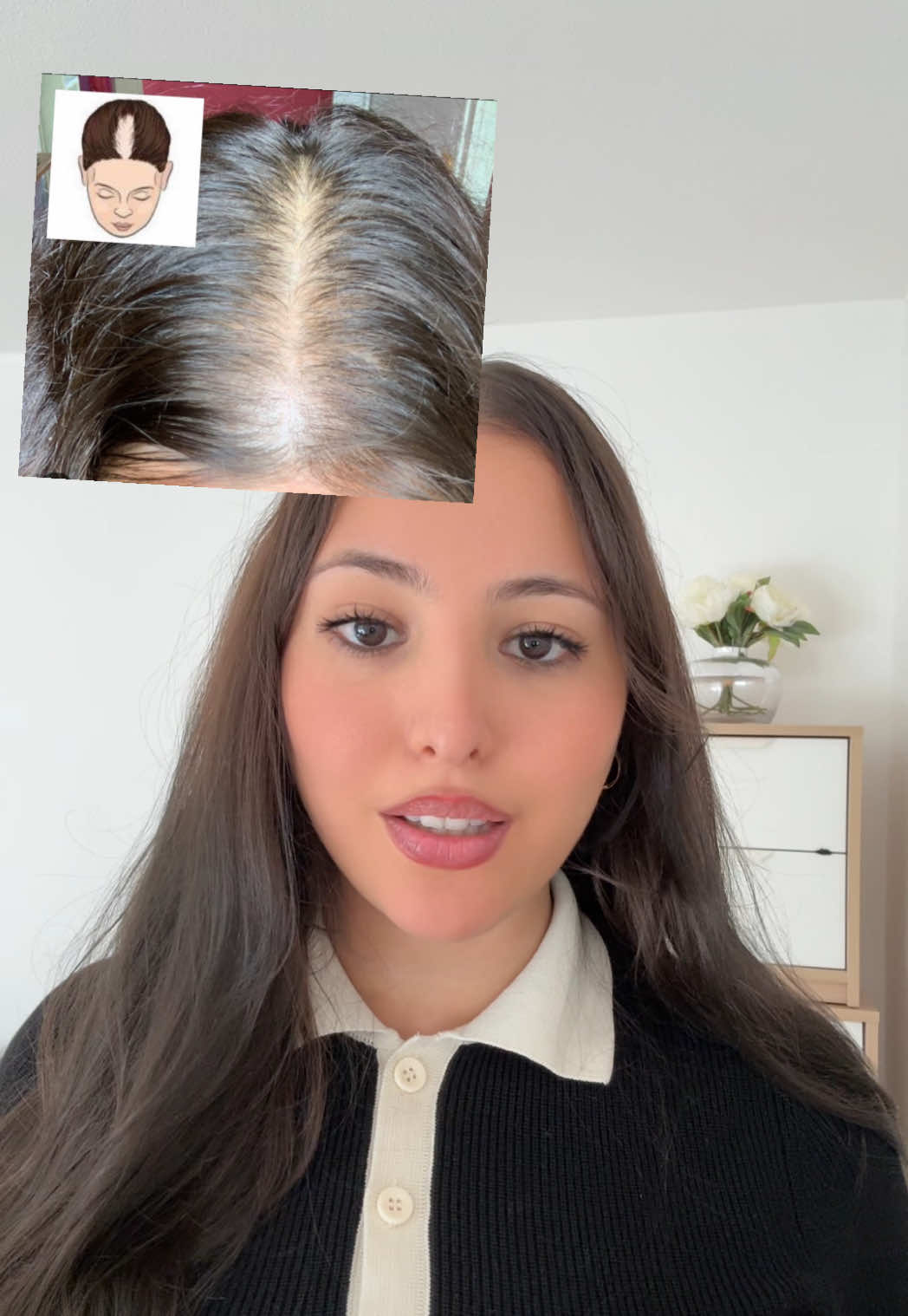 L’alopécie androgénétique, c’est la forme la plus courante de chute de cheveux. Ça se voit par une raie qui s’élargit. Il faut agir vite, car plus on attend, plus les follicules s’atrophient et moins les traitements sont efficaces. Un diagnostic précoce permet de ralentir la chute et de préserver la densité. 