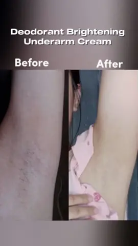 For brighter underarms, use consistently. 🔥 Visibly improves underarm darkness in just 30 days with active brightening agents.