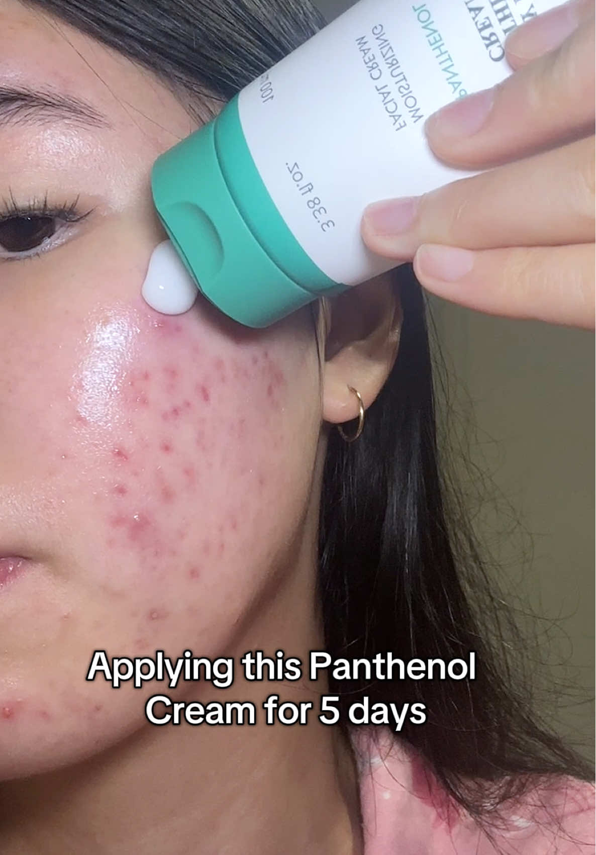 Purito Mighty Bamboo Panthenol Cream Yesstyle Code: LUVKAT13 #purito #panthenolcream #acnetreatment #realpostacnecream #realpostacnecreamchallenge @PURITO SEOUL @YesStyle @YesStyleInfluencers 