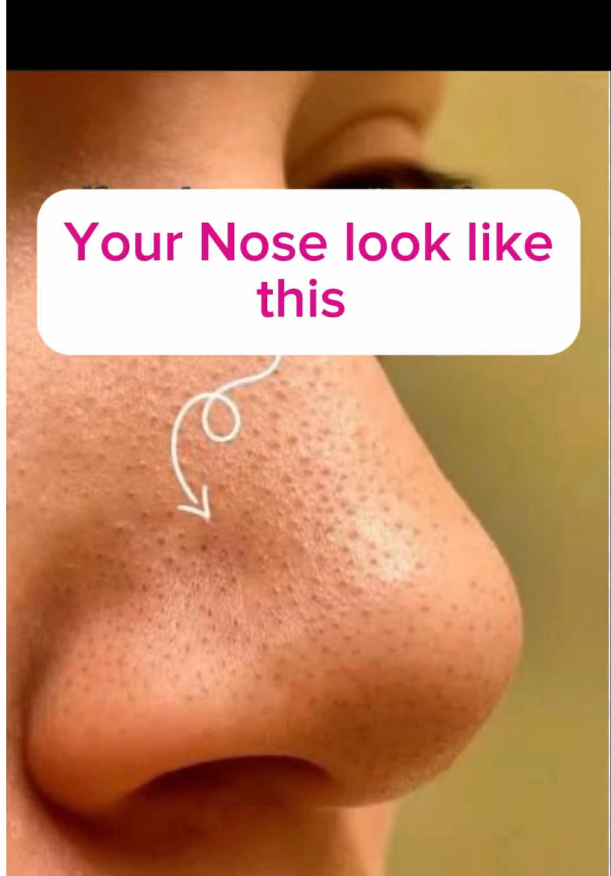 Your nose look like this #bestdermatologist #bestdermatologistindubai #drjaveria #bestdermatologistinuae #bestskincare 