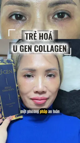 Thay vì iêm tăng sinh collagen thì chúng ta iêm luôn collagen mọi người nhé 👏😍 #MINHPHUONGCLINIC #FILLER #ugen #collagen #MESO 