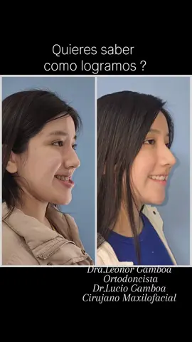 Ortodoncia Quirúrgica con Cirugía Ortognática  Hoy le presentamos este antes y después de Nikole Ella presentaba, arco del.maxilar superior estrecho, prognatismo mandibular con retrusión del maxilar sup, asimetría facial. La Dra Gamboa  realizo una ortodoncia Pre-Quirúrgica (brackets estéticos, expansión del maxilar superior) La operamos de una Cirugía Ortognática Bimaxilar. Cirujajno Maxilofacial: Dr Lucio Gamboa La cirugía y la ortodoncia Quirúrgica que le realizamos no solo nos da cambios funcionales sino también estéticos.  Comenta su te gusto el resultado ⬇️ #ortognaticaperu #cambiosfaciales  #cirugiamaxilofacial #drluciogamboa  #mandibulagrande   