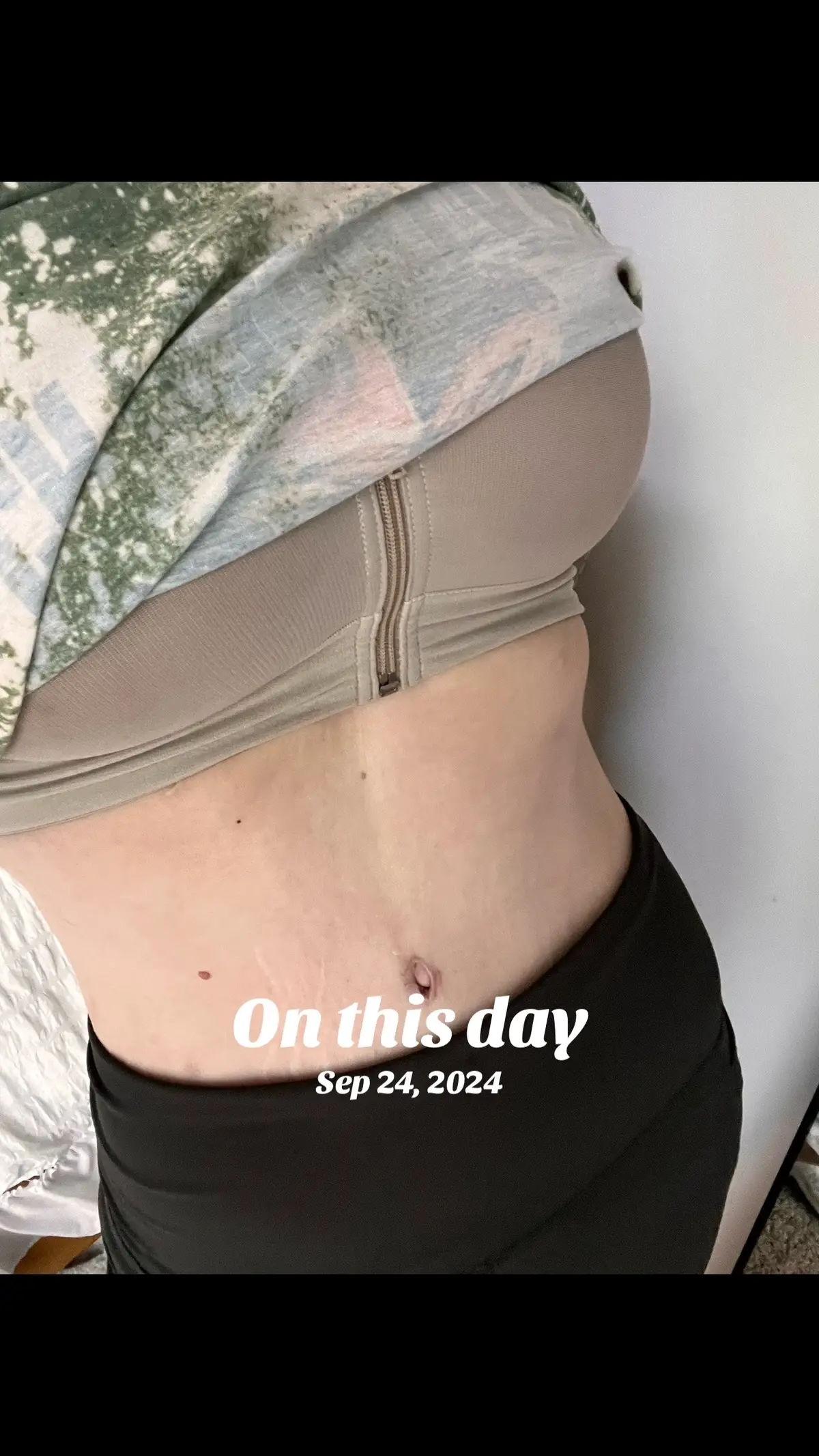 #onthisday #tummytuck #mommymakeover 