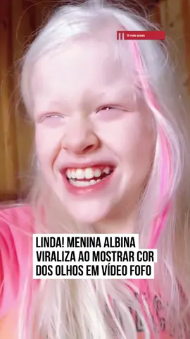 ✨ Que linda! Um vídeo de uma #meninaalbina conquistou milhões de visualizações ao mostrar, de forma divertida e cheia de simpatia, a cor única de seus olhos. 💜 Na cena, ela aparece sorrindo e brincando com a câmera, enquanto responde a uma dúvida frequente sobre sua #íris. Descrita como “doce, engraçada e branquinha como algodão, com olhos lilases”, a pequena derreteu #corações nas redes. Fofura demais, né? 🥹💜 #tiktoknotícias  🎥 @Gianedias_ (ig) | @myhoodbr