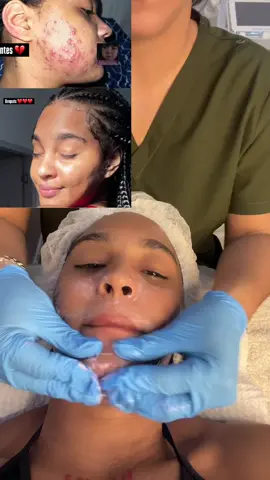 @Genesisspaybeauty ✨ El Hollywood Peel, también conocido como peeling de carbón activado con láser, es uno de los tratamientos más glamorosos y efectivos para rejuvenecer la piel sin necesidad de tiempo de recuperación. Ideal para pieles apagadas, con poros dilatados, manchas o líneas finas, este procedimiento ha ganado fama por su uso entre celebridades como Kim Kardashian y Angelina Jolie. 🖤 ¿Cómo funciona? 1. Aplicación de carbón activado: Se coloca una fina capa sobre la piel, que penetra en los poros. 2. Láser Nd:YAG: El láser barre el carbón, exfoliando suavemente la piel y estimulando la producción de colágeno. 3. Efecto dual:    - Elimina células muertas y exceso de grasa.    - Mejora textura, luminosidad y firmeza. 🌟 Beneficios clave - Piel más radiante y uniforme desde la primera sesión. - Reducción de líneas finas, manchas y poros abiertos. - Estimula el colágeno sin ser invasivo ni doloroso. - Mejora la apariencia de acné y cicatrices superficiales. 📆 Frecuencia recomendada - 1 sesión ofrece resultados visibles por unos 30 días. - Para resultados más duraderos: 3 a 6 sesiones, cada 2 a 4 semanas. - Mantenimiento: cada 4 a 6 meses. 🛡️ Cuidados post-tratamiento - Evitar el sol directo. - No usar maquillaje por 24–48 horas. - Mantener la piel hidratada y no rascarse. #acne #spa #paratiiiiiiiiiiiiiiiiiiiiiiiiiiiiiii 