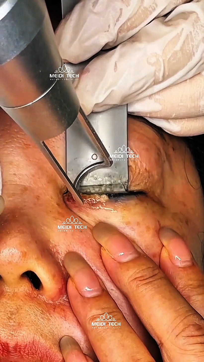 #tattooremoval #eyebrowtattooremoval #tattoolaserremoval #removetattoo #eyebrowtattoo #pmu #microblading #permanentmakeup #ombrebrows #eyebrowstattoo #microbladingartist #microbladingeyebrows #pmubrow #microbladingtraining #eyebrowtattoo #eyebrow  #browshapping #powderbrows #eyebrowdesign #ombrepowdereyebrows #eyebrowembroidery #browlamination #browtint #pmueyebrows #pmuacademy #pmutraining #microbladingbrows #eyebrowtattoos #microshading #browtraining #eyebrowpigmentation #eyebrowtutorial #brow 