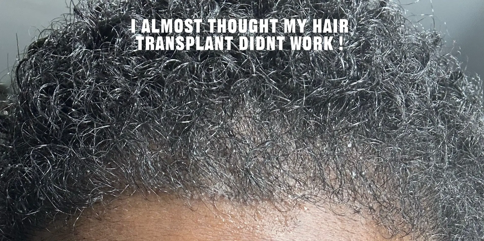 #trusttheprocess #hairtransformation #fyp #hairtransplant #instanbul 