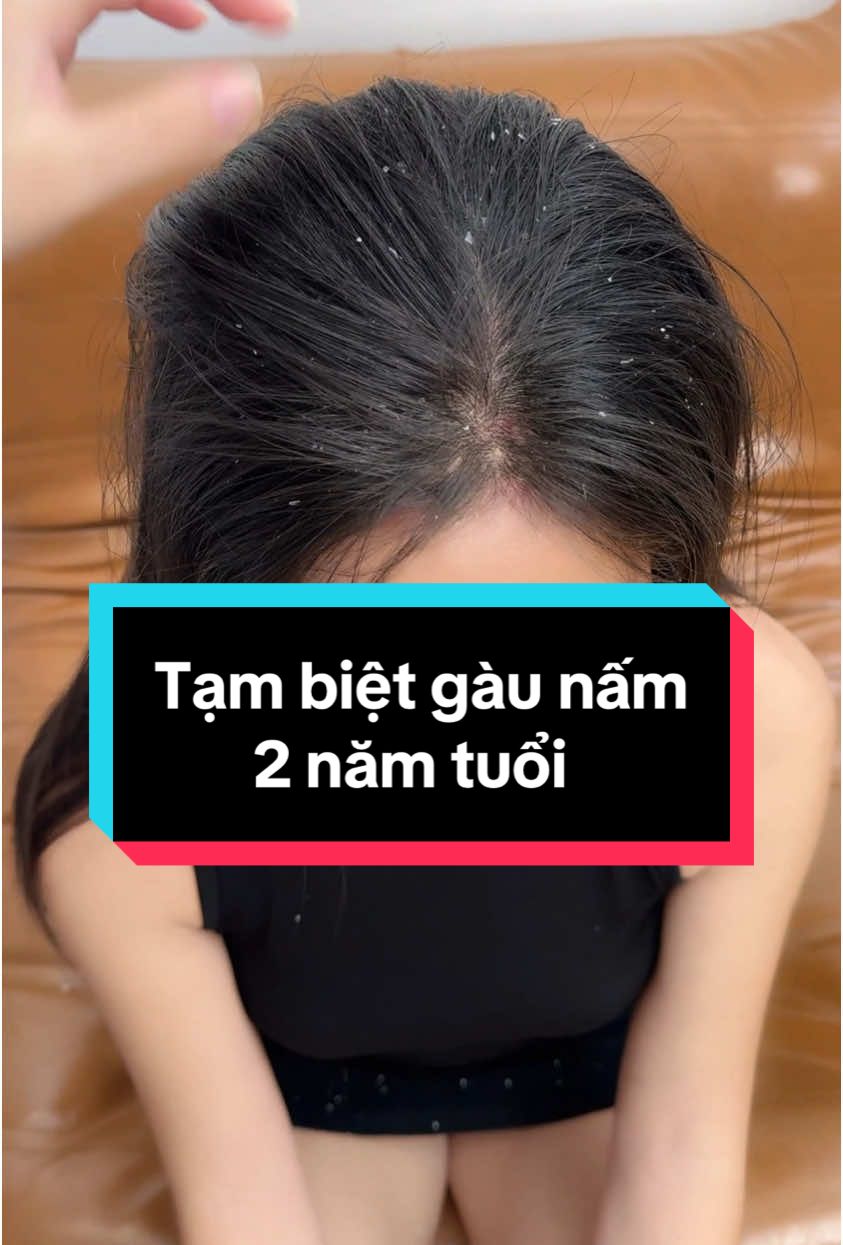 Tạm biệt gàu ngứa 2 năm tuổi #xitduongtoc #xitnamgau #namnung #xuhuong 