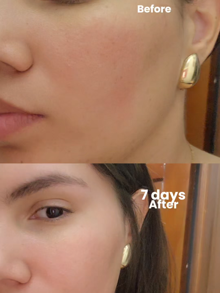 Say goodbye to acne in just 7 days ✨️ #Purito #PanthenolCream #AcneTreatment #RealPostAcneCream #RealPostAcneCreamChallenge @PURITO SEOUL 
