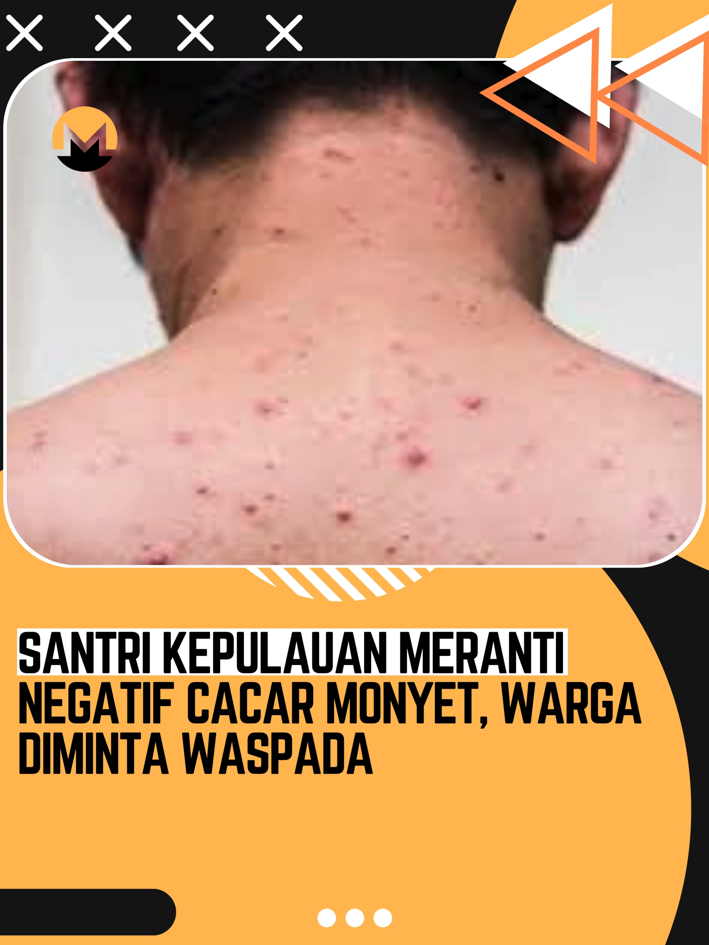 Pemeriksaan laboratorium terhadap dua santri asal Kabupaten Kepulauan Meranti yang sebelumnya dicurigai terinfeksi cacar monyet (Monkeypox/Mpox) akhirnya menunjukkan hasil negatif.  Kepastian ini disampaikan oleh Pelaksana Tugas (Plt) Kepala Dinas Kesehatan Provinsi Riau, Ns Widodo, usai menerima laporan resmi dari Balai Besar Laboratorium Biologi Kesehatan Kementerian Kesehatan RI.