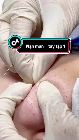 Khách mụn ẩn mụn đầu đen siêu nhiều , nhưng khách lại sợ đau nhưng khách nhà em cứ yên tâm nằm xuống để em lo #sinhvien #nanmunbangtay #phunhuan #nanmunphunhuan 