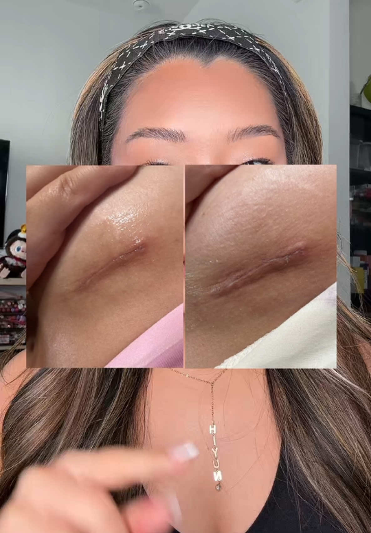 Finallly BACK IN STOCK AND ON SALE #tiktokshoprestock #tiktokshopcreatorpicks #kickstart #tiktokshopblackfriday #blackfriday #scar #breastaugmentation #plasticsurgery #acnescars @Prequelskin #prequelskin #skincare 