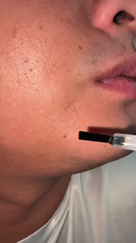 Next time buong mukha naman 😆 #blackheads #whiteheadsremoval #blackhead 