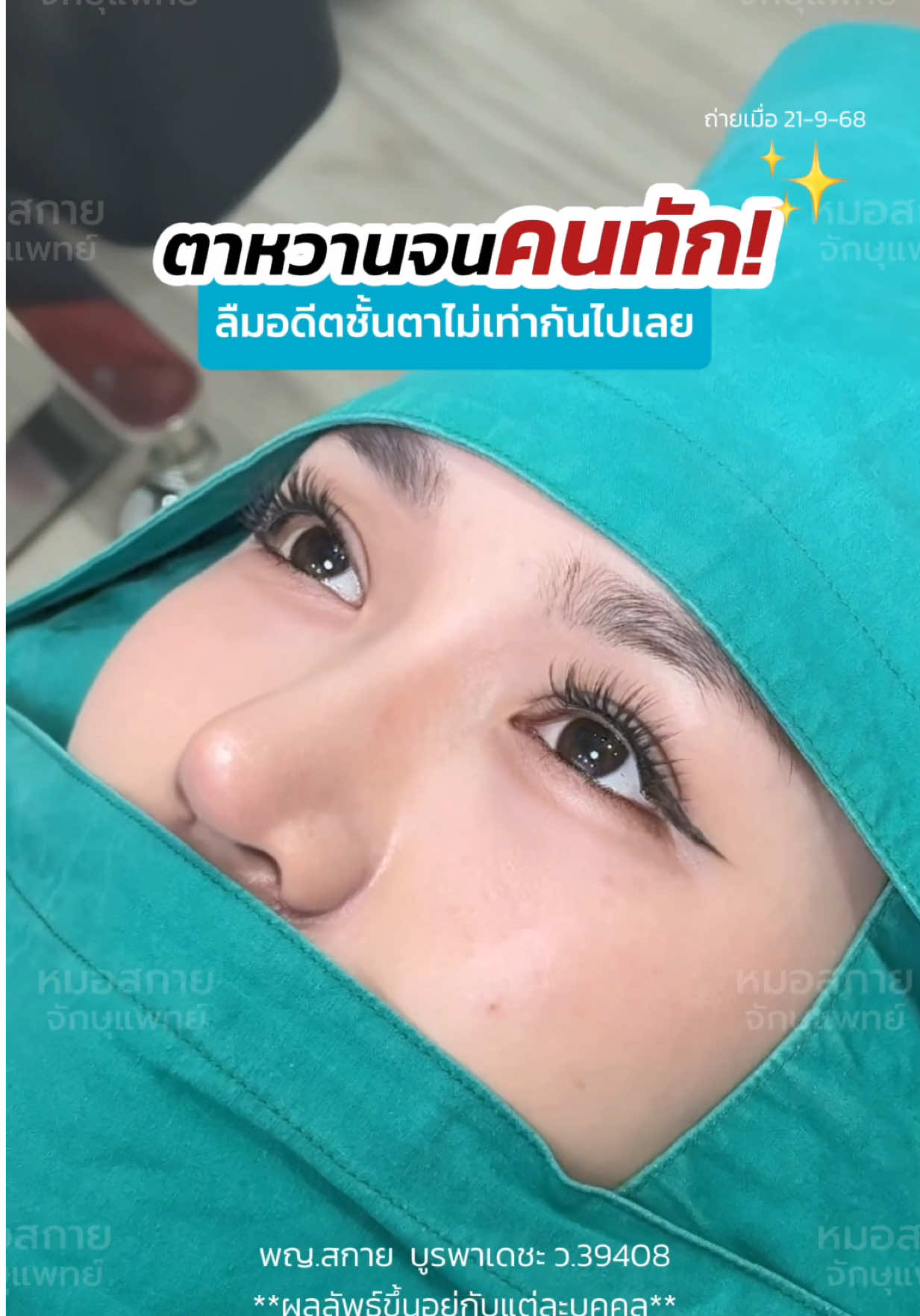 ตาหวานจนคนทัก⁉️ ลืมอดีต #ชั้นตาไม่เท่ากัน ไปเลย🤭 #ทำตาสองชั้น #หมอสกาย #skyclinic #ทําตาที่ไหนดี 