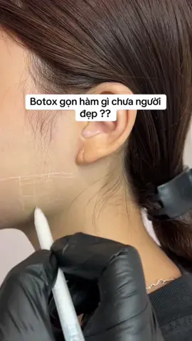 Botox gọn hàm gi ch ng đẹp ? #xuhuong #tiemfileruytin 