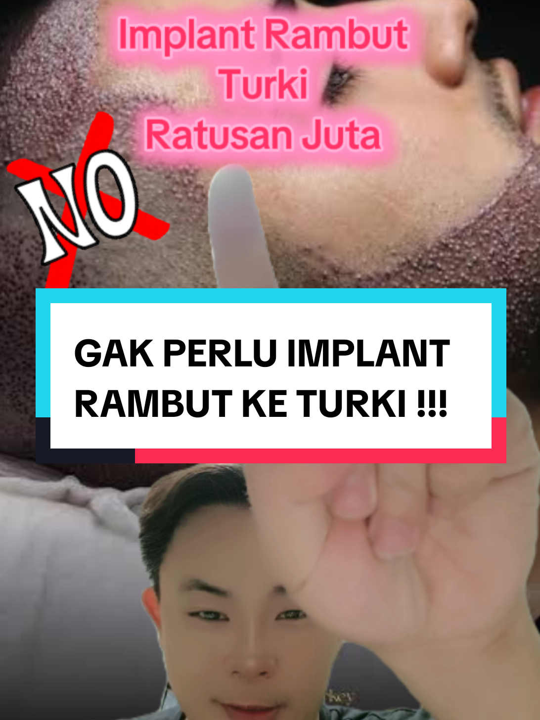 Gak perlu keluar uang ratusan juta Implant rambut ke turki, instant gak sampai 30 detik, pakai bedak garis rambut, solusi rambut tipis, botak atau uban, beli 2 lebih murah gratis ongkir #bedakgarisrambut #bedakrambut #bedakrambutinstant #lanlslo #lanlslohairlinepowder 