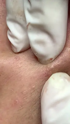 🥰#78 #phuyen #xuhuong #nặnmụntuyhoà #nặnmụnbằngtay 