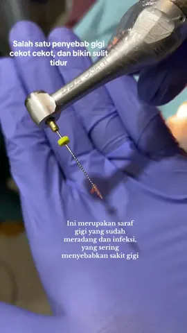 semalam gak bisa tidur karena sakit gigi kambuh.  alhamdulillah pagi ny dikasih gumora sekali pakai sakit ny sembuh #promomakangajian #gratisongkir #gusibengkak #obatsakitgigiampuh #gumoraobatsakitgigi 
