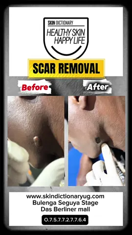 Laser scar resurfacing uses lasers to reduce the appearance of wrinkles and scars, to even out skin coloring (pigmentation), to tighten skin and to remove lesions. #scar #laserscarremoval #scarremovaltreatment 