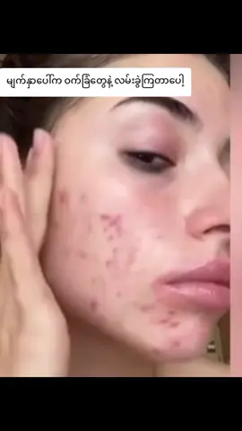 #ဝက်ခြံပျောက်ချင်မှသုံး#hcသလဲသီးမျက်နှာသစ်ဆပ်ပြာ #Myalay #ရန်ကုန် 