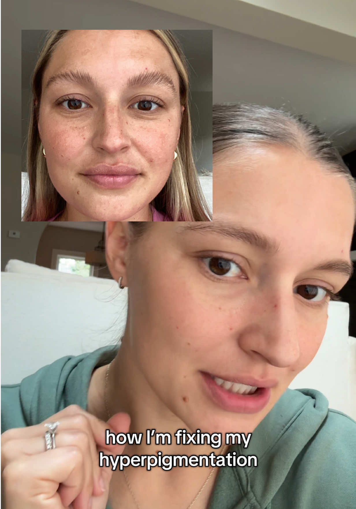 My number 1 at home skincare tool - has helped me so much with hyperpigmentation, acne, and anti-aging #hyperpigmentation #hyperpigmentationtreatment #tiktokshopcreatorpicks 